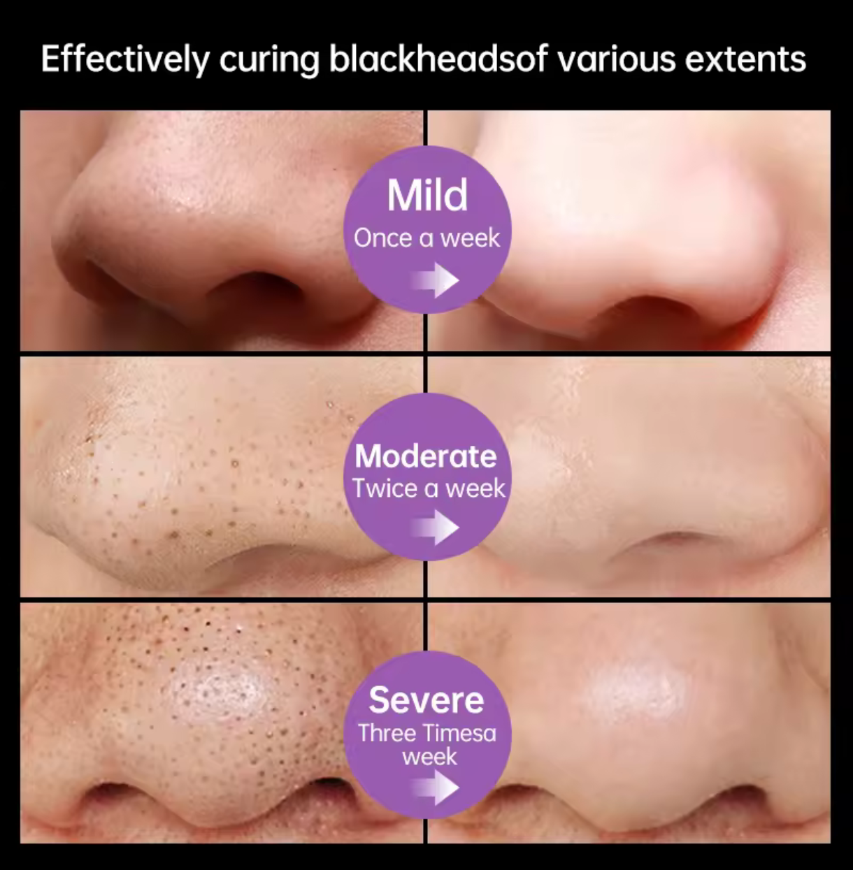 Mascarilla de carbón para blanquear los poros